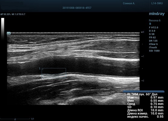 auto-imt-сонная-артерия