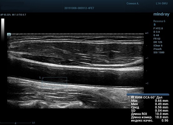 auto-imt-сонная-артерия